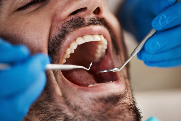 Best Root Canal Emergency Dentist  in Milan, MO